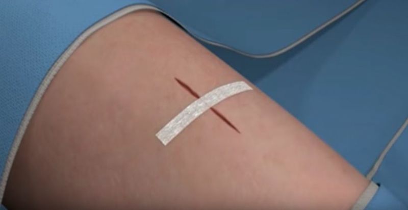 Non-Invasive Bandage Stitches