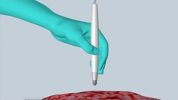 Cancer-Detecting Surgical Pens