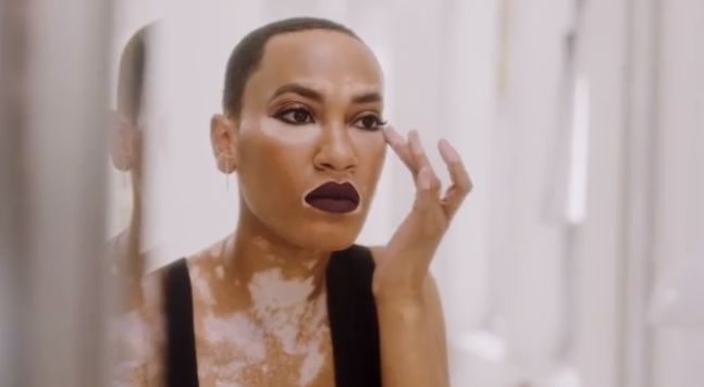 Vitiligo Model-Inclusive Beauty Campaigns