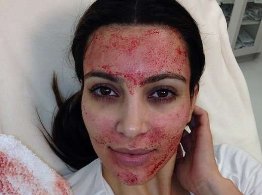 Blood-Recycling Beauty Facials