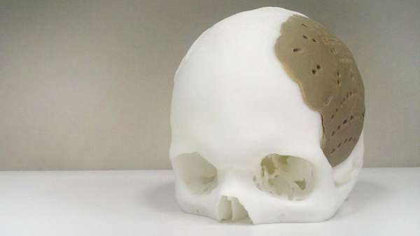 3D-Printed Skull Implants