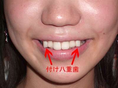 Reverse Orthodontia Procedures